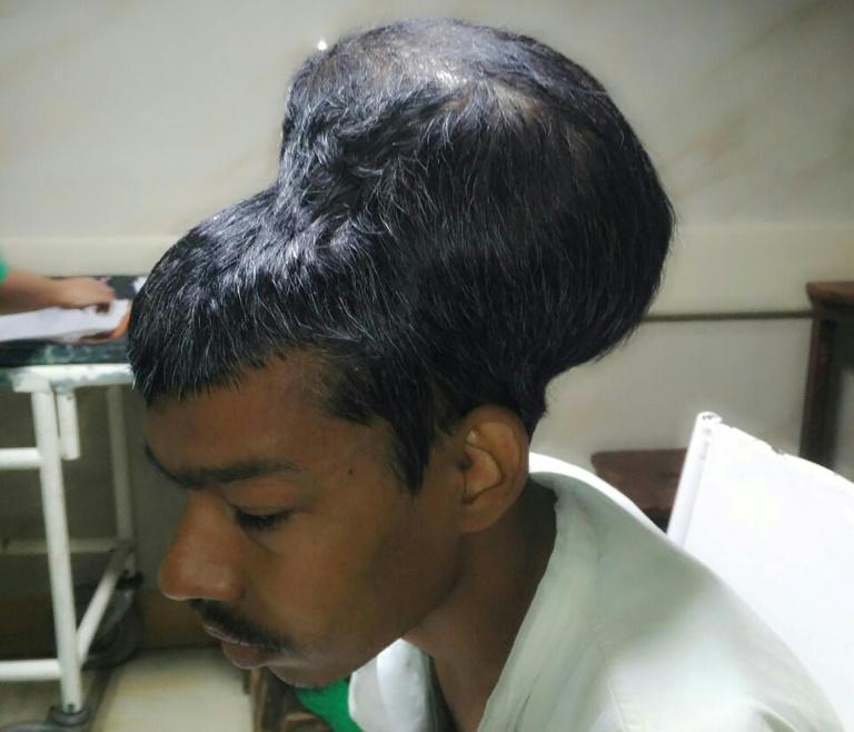 Indian Surgeons Remove ‘Heaviest Recorded’ Brain Tumor