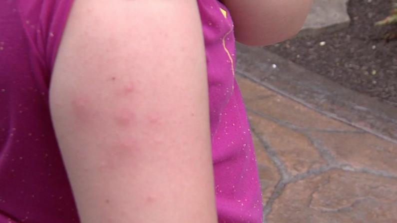 Mosquito Bite Dos and Don’ts