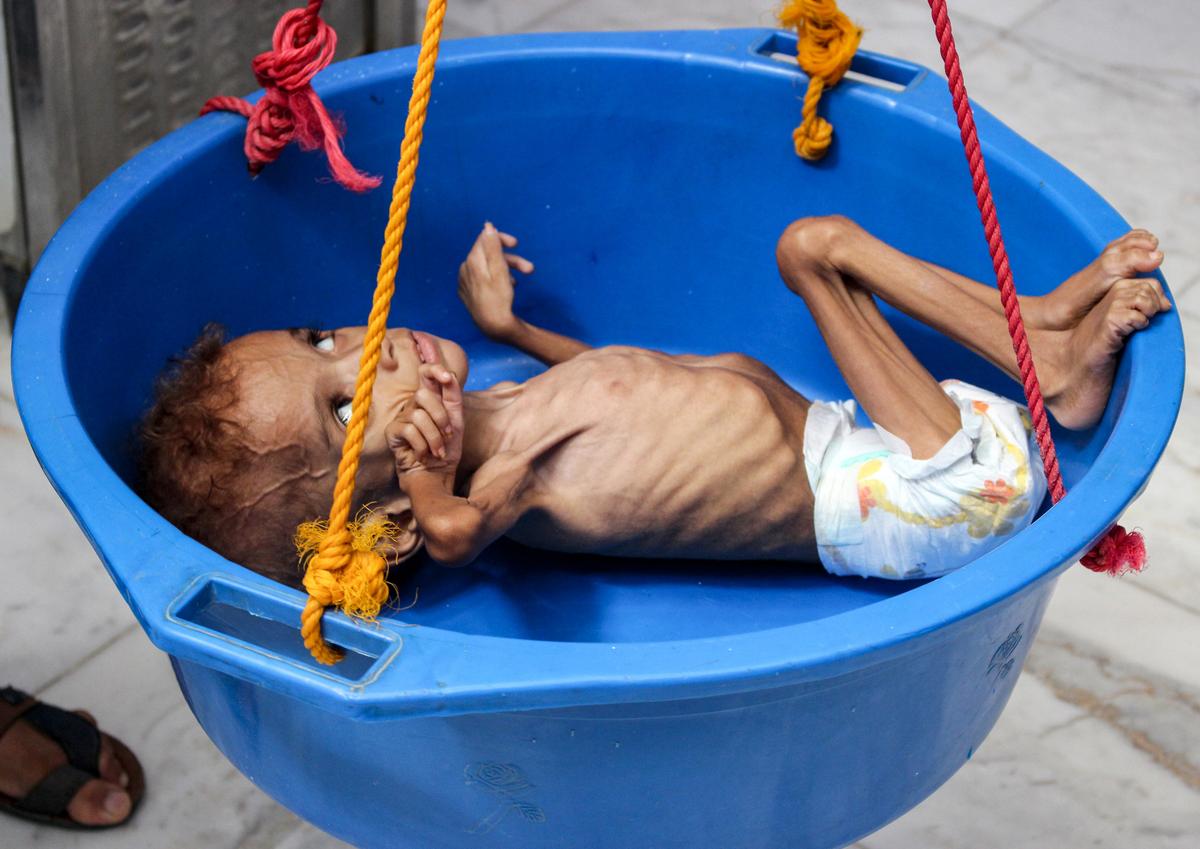 Yemen’s Nightmare: War Brings Famine