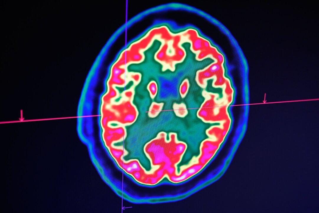 Scientists Claim They May Have Discovered the Cause of Alzheimer’s