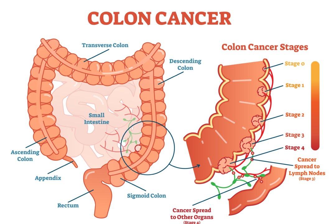 Vegetarians Can Also Get Colon Cancer? 6 Tips to Keep Your Vegetarian Diet Healthy