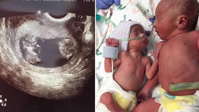 Mom Refuses Doctors’ Advice to Terminate One of Her Twins, 34 Weeks Later It’s the ‘Best Decision’
