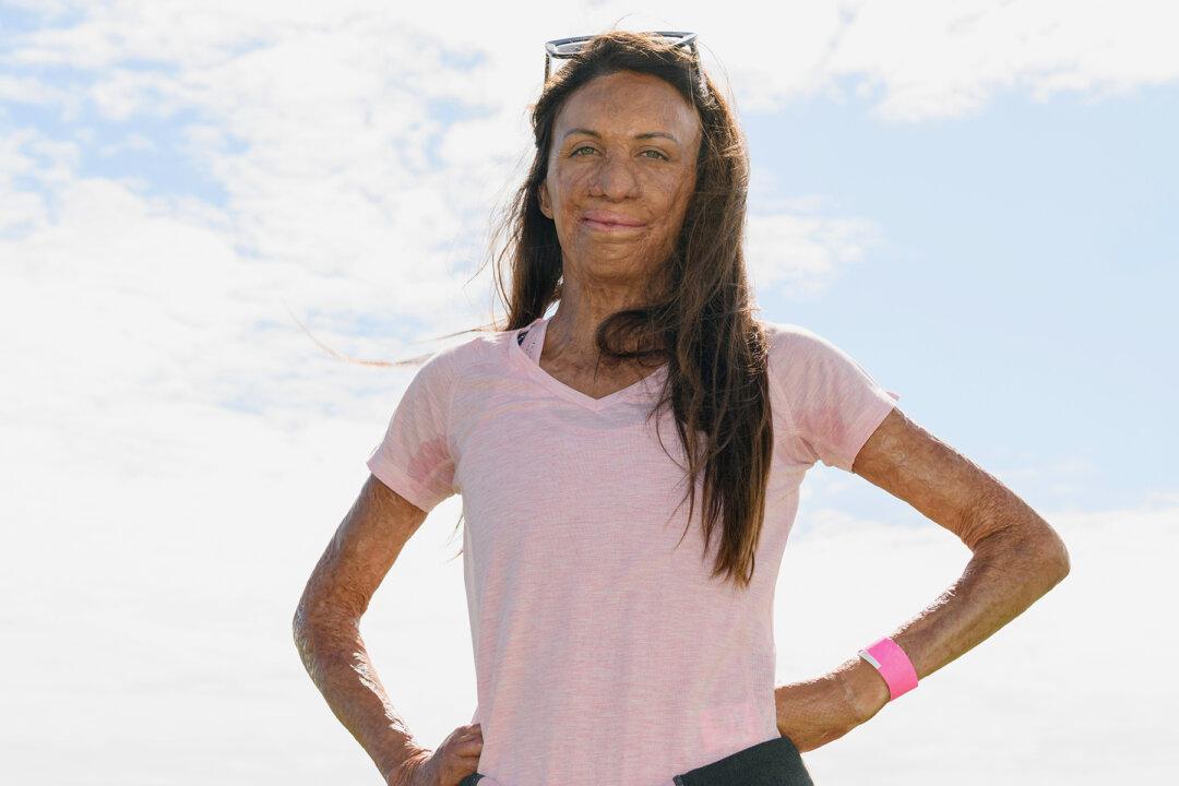 True Love Story of a Former Model Who Suffers Burns on Two-Thirds of Her Body