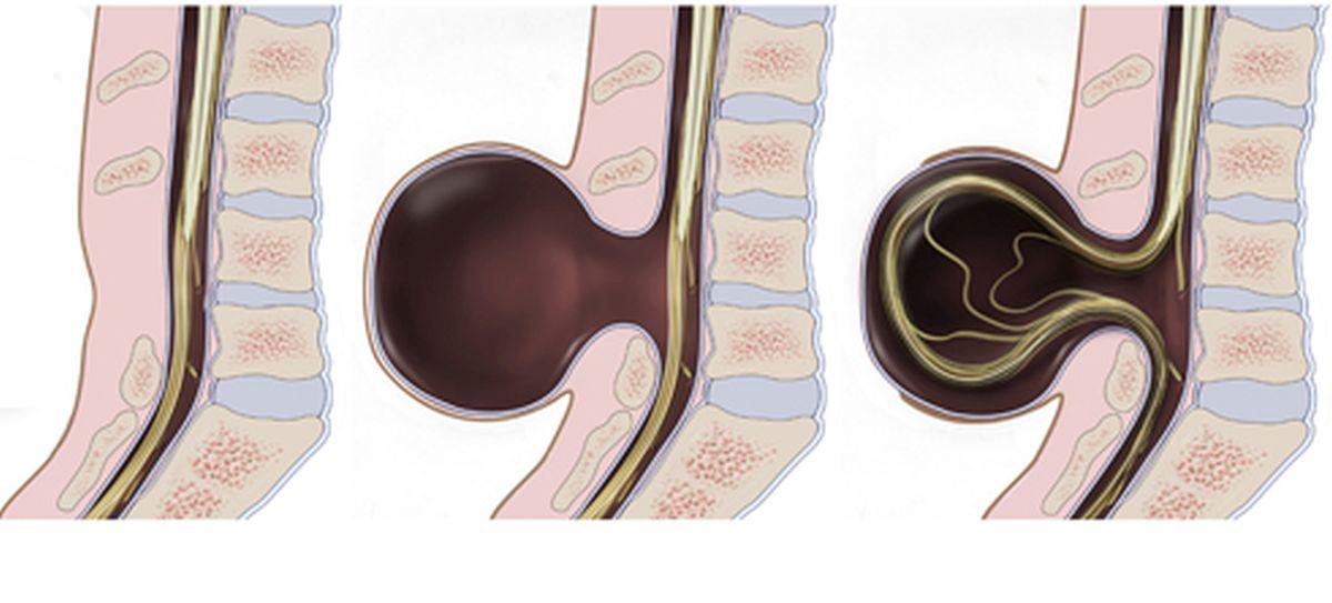 Boy, 2, With Spina Bifida Now Running After Walking for the First Time