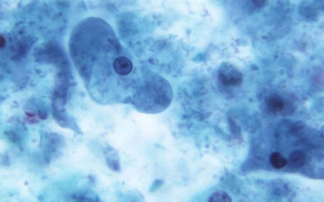 E. Coli Outbreak Linked to Packaged Salads Sickens People in 6 States