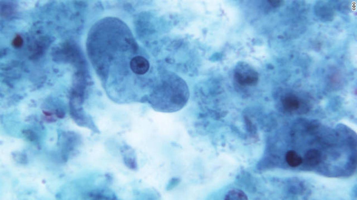 E. Coli Outbreak Linked to Packaged Salads Sickens People in 6 States