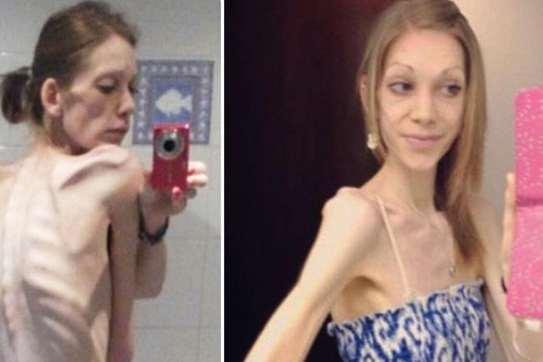 On the Brink of Death, Anorexic Teen Weighed 55lb – but Bodybuilding Saved Her Life