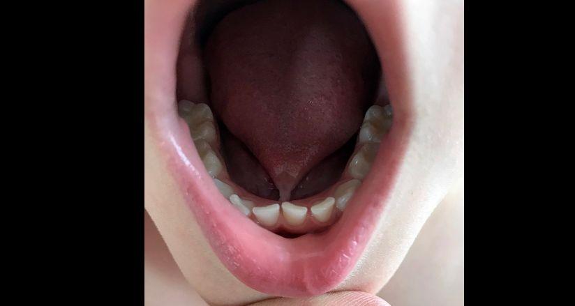 Boy Believed to Be Nonverbal Can Speak After Dentist Finds He’s ‘Tongue-Tied’