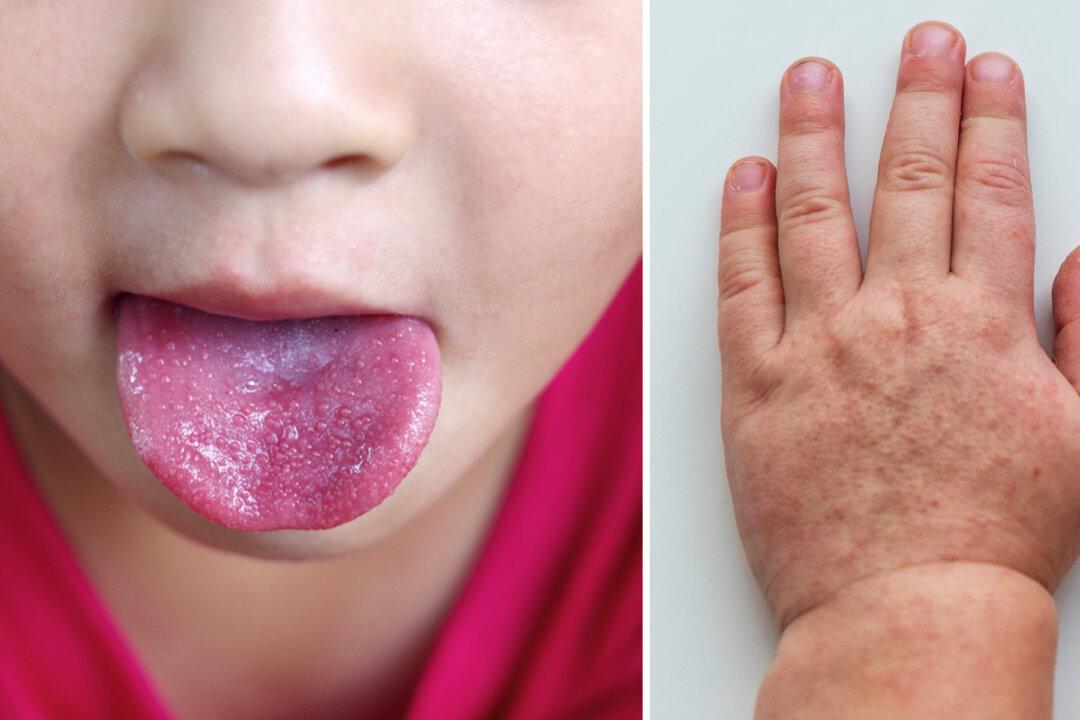 4 Top Tips About Scarlet Fever That Every Parent Should Know