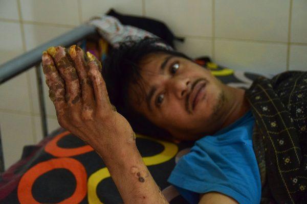 Abul Bajandar at Dhaka Medical College Hospital in Dhaka on Jan. 31, 2018<br/>(Sam Jahan/AFP/Getty Images)