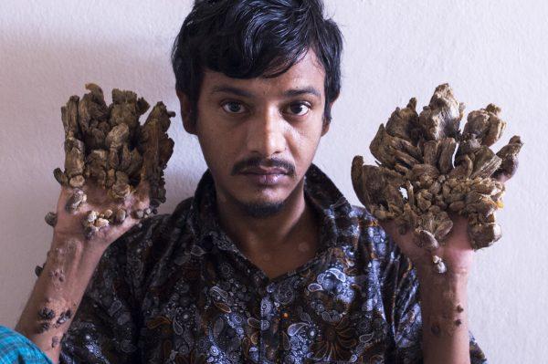 Abul Bajandar sits at Dhaka Medical College Hospital in Dhaka on June 24, 2019. (Munir Uz Zaman/AFP/Getty Images)