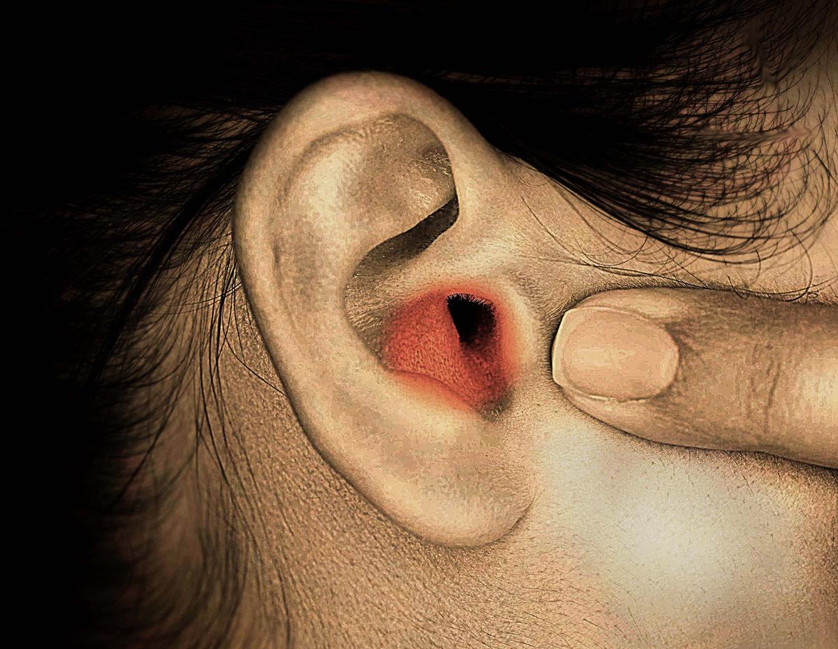 Illustration - Shutterstock | <a href="https://www.shutterstock.com/image-photo/closeup-human-ear-inflamed-area-young-727656973?studio=1">Stefano Garau</a>