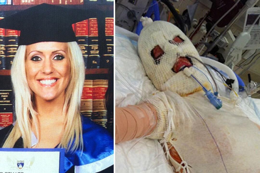 Lady Brutally Burned Alive. 3 Years Later, She Removed Mask to Reveal Her Perfect Face