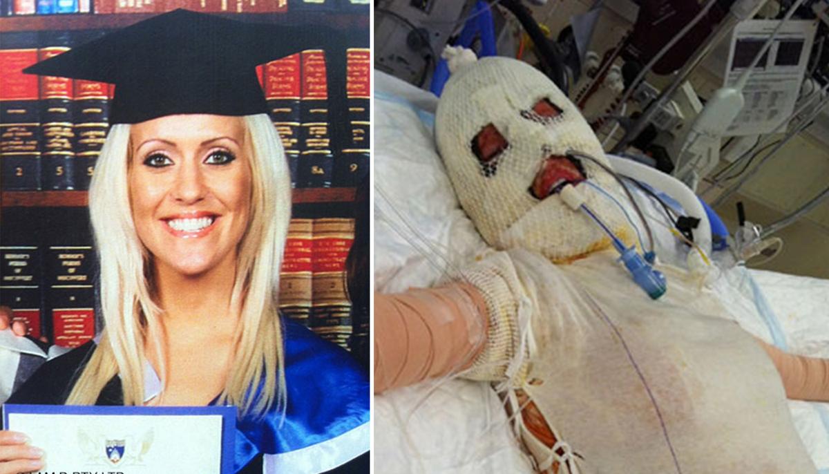 Lady Brutally Burned Alive. 3 Years Later, She Removed Mask to Reveal Her Perfect Face