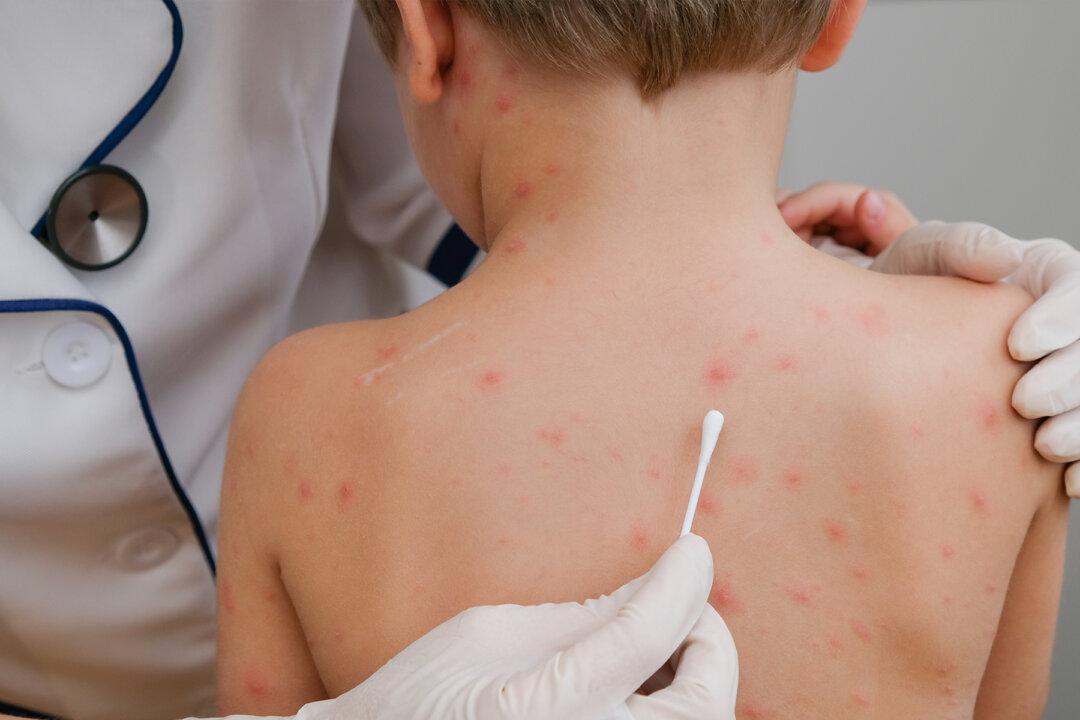 Little Boy With Chicken Pox Cries in Pain, Then Mom Discovers Doctors’ Lethal Mistake