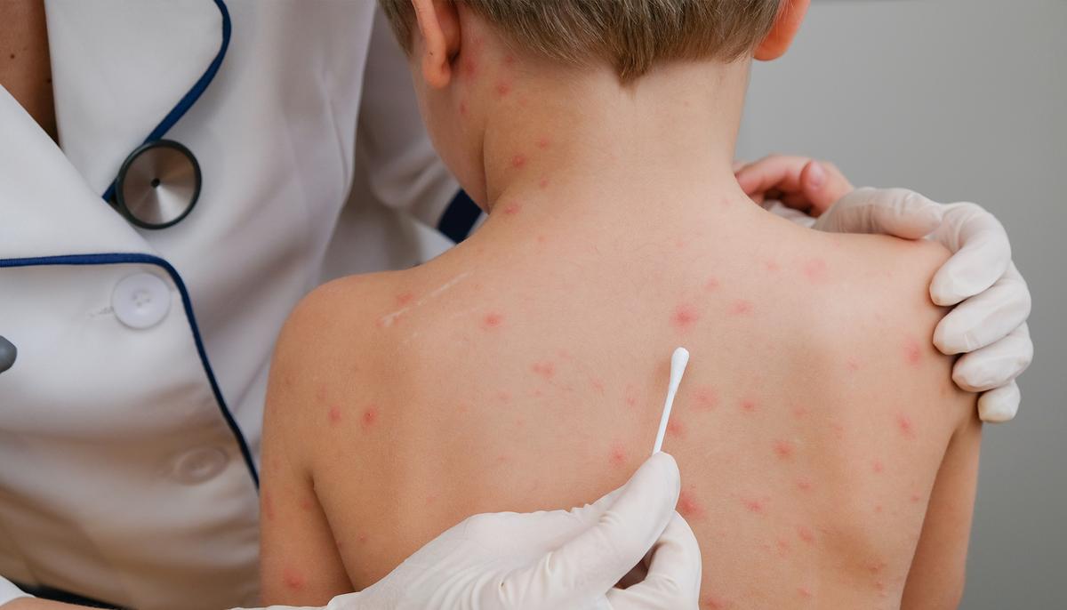 Little Boy With Chicken Pox Cries in Pain, Then Mom Discovers Doctors’ Lethal Mistake