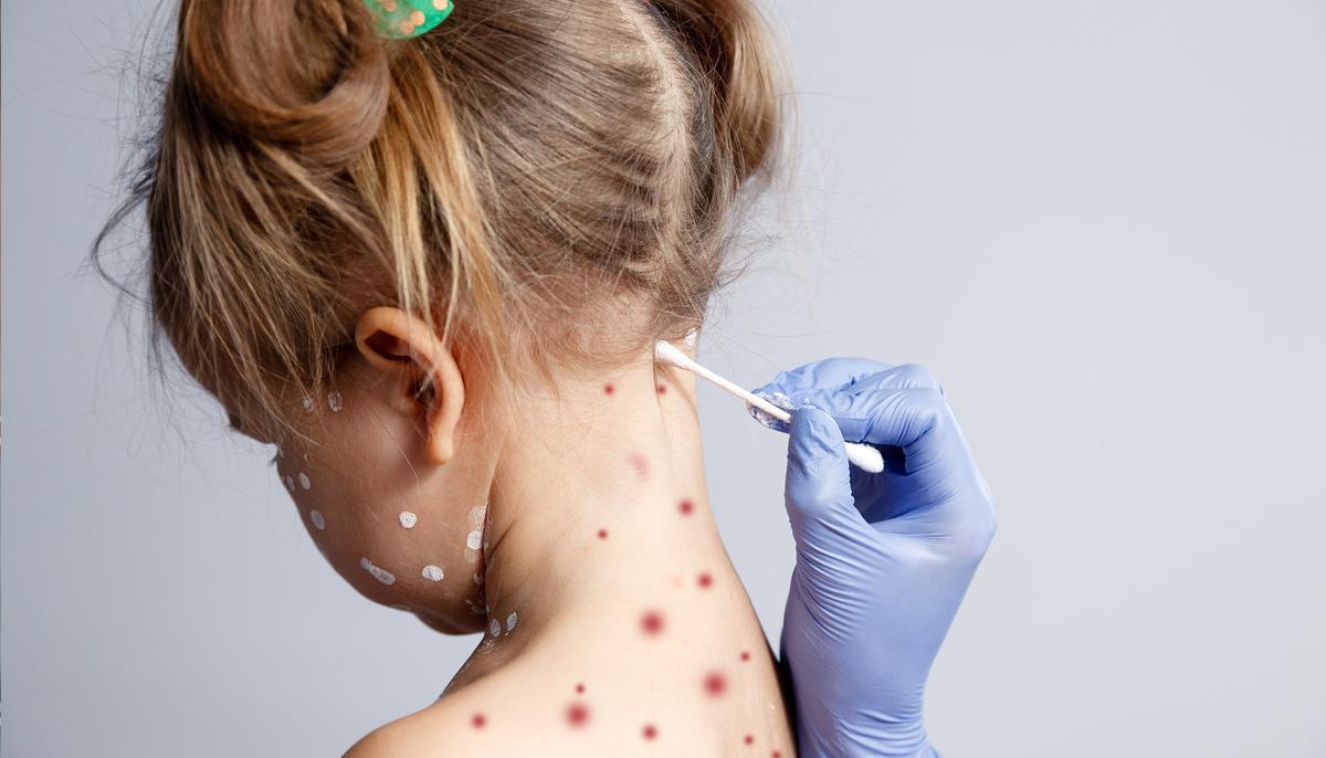 6-Year-Old’s Plan to Skip School Backfires When Her ‘Chicken Pox’ Won’t Come Off