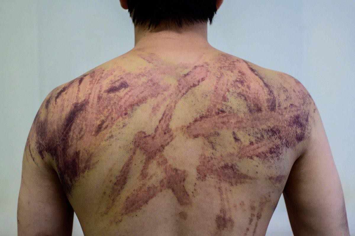 Calvin So, 23, a resident of Yuen Long, shows his wounds and bruises in a hospital corridor in Hong Kong on July 24, 2019. (Anthony Wallace/AFP/Getty Images)