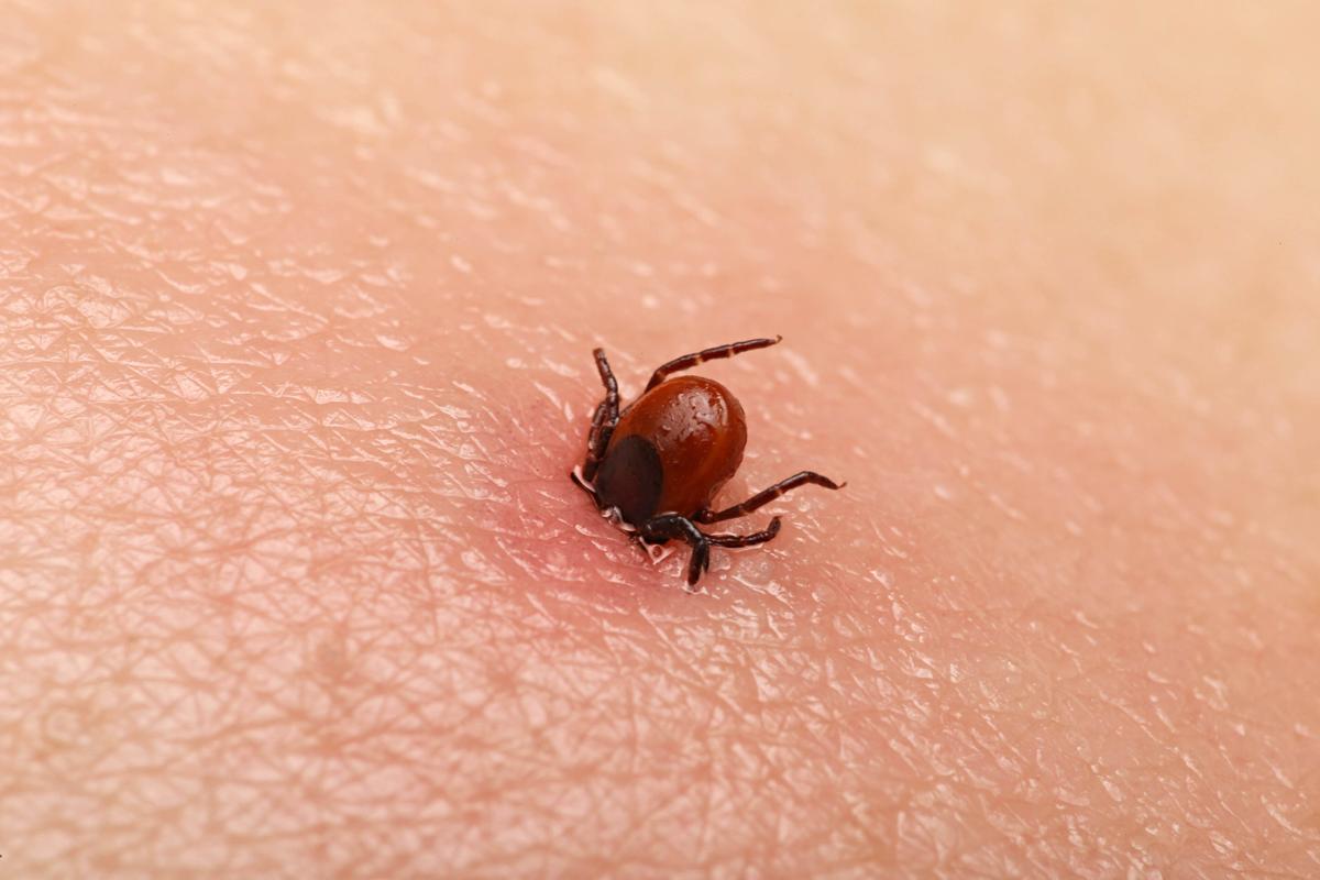 Tick Bites Leave Girl Unable to Move as Doctors Diagnose Rare ‘Tick Paralysis’