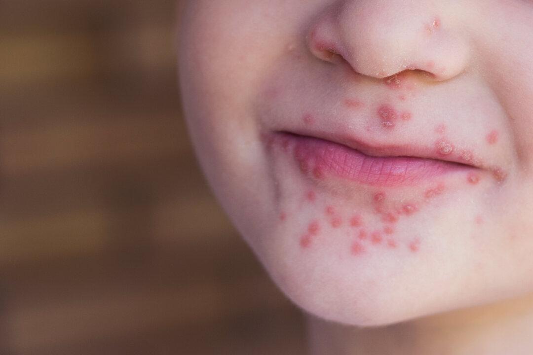 Tot Caught Virus That Could Leave Him Blind From a Single Kiss, Now Mom Issues Warning