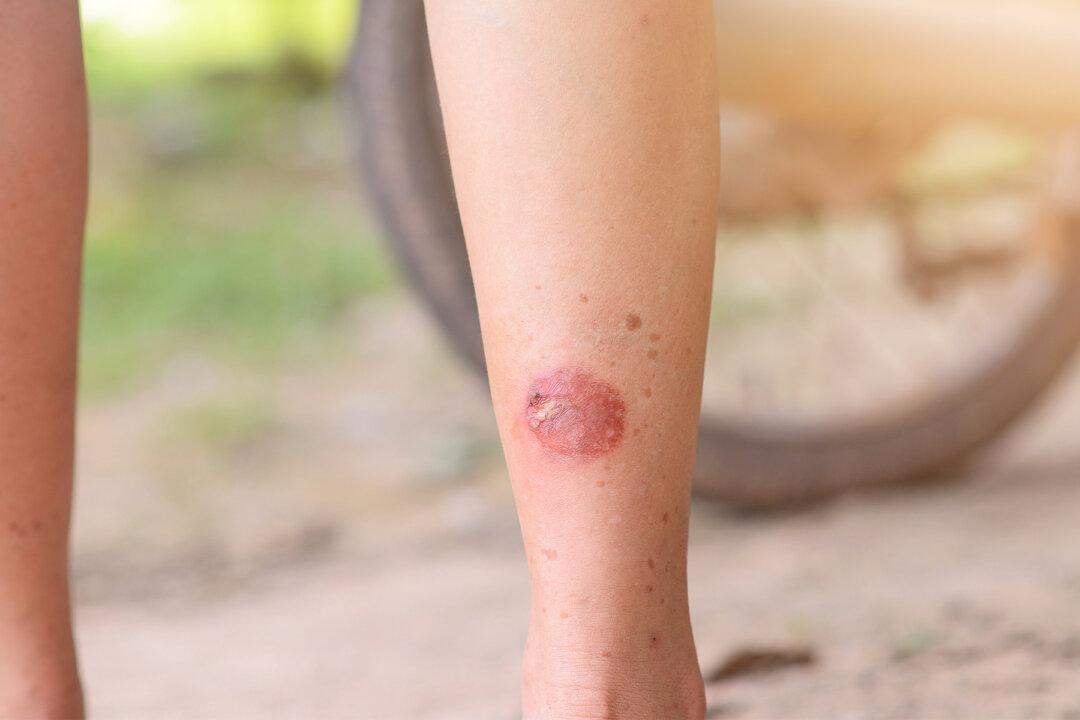 10-Year-Old Boy Dies 9 Days After Strange Mark Appears on His Leg During Football Game