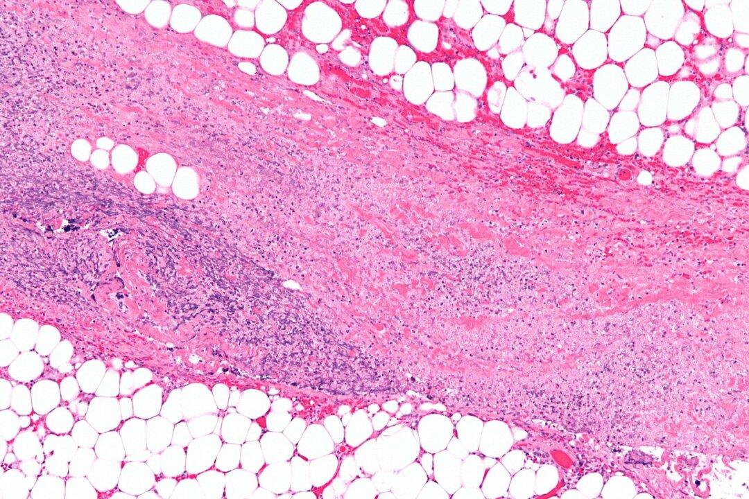 Florida Man Who Had 25 Percent of Skin Removed Dies From Flesh-Eating Bacteria