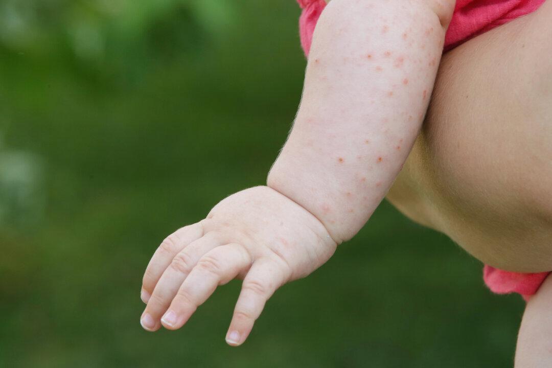Baby Is Born With Chicken Pox-Like Lumps, but It Turns Out to Be 1-in-100,000 Disease