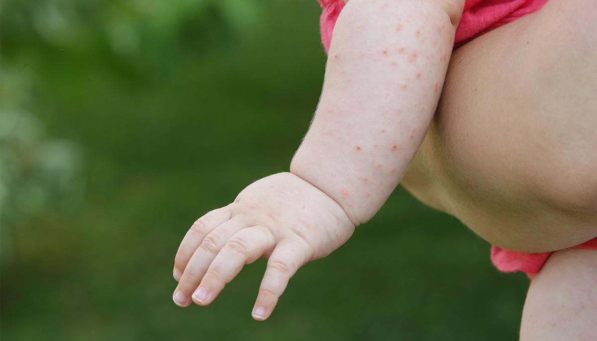 Baby Is Born With Chicken Pox-Like Lumps, but It Turns Out to Be 1-in-100,000 Disease
