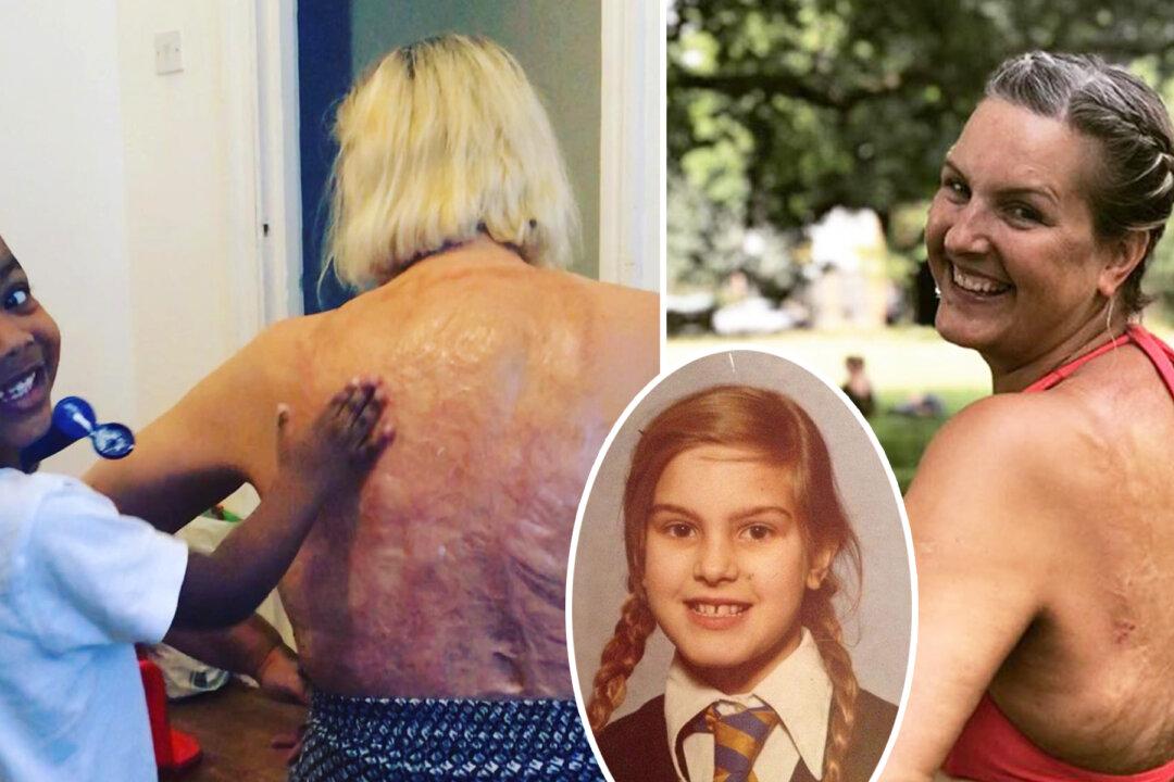 Burn Victim Starts Body-positive Campaign After 47 Years of Shame: ‘My Scars Are Wonderful’