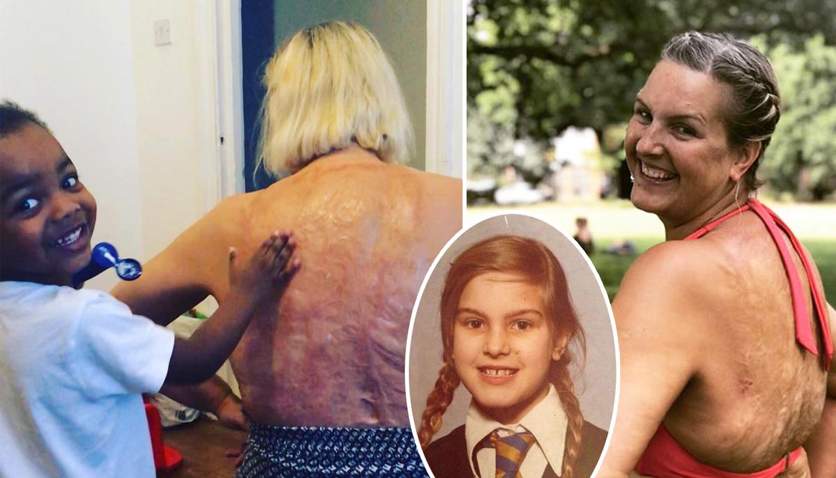 Burn Victim Starts Body-positive Campaign After 47 Years of Shame: ‘My Scars Are Wonderful’
