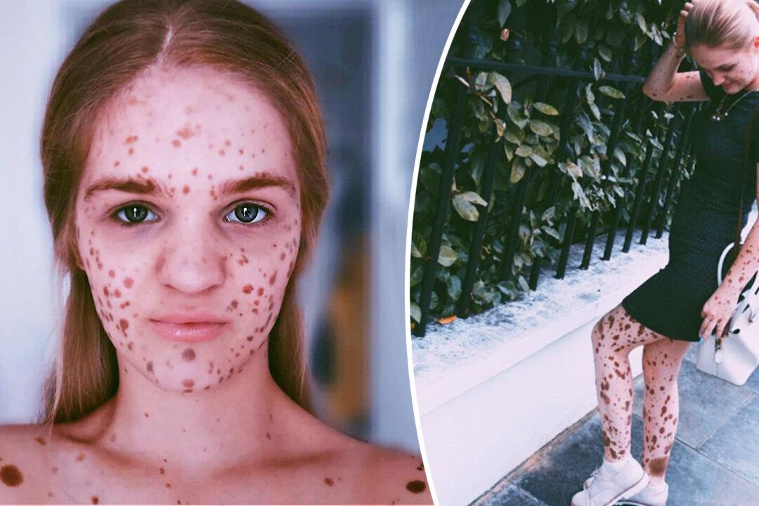 Young Woman Was Bullied for Her Birthmarks–Now She Is a Model and Advocates Body Positivity