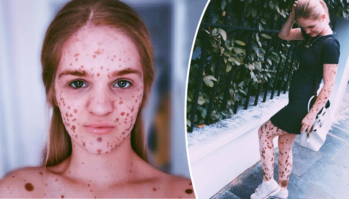Young Woman Was Bullied for Her Birthmarks–Now She Is a Model and Advocates Body Positivity