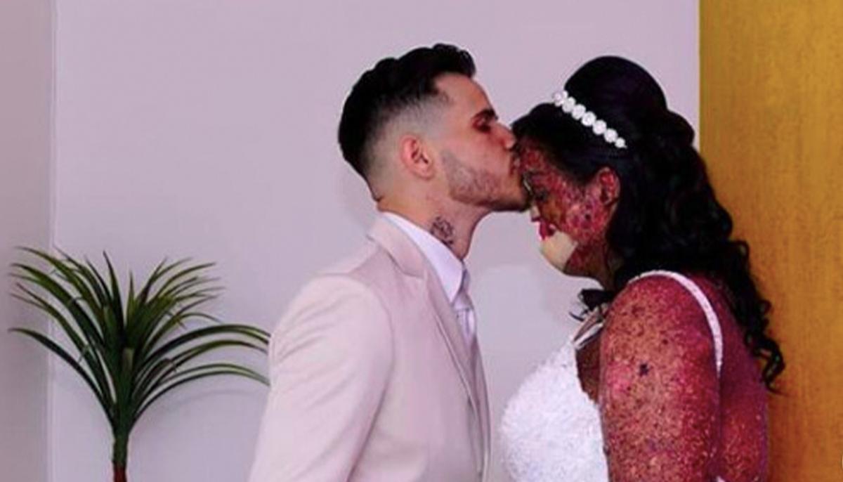 Woman With Rare Skin Disease Finds True Soulmate: ‘Love Exists, Believe Me!’
