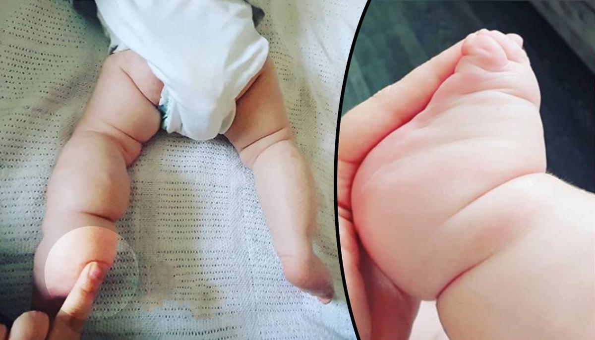 Mom Notices Baby Girl’s ‘Clubbed Foot,’ Fears the Worst–but It Wasn’t What She Expected