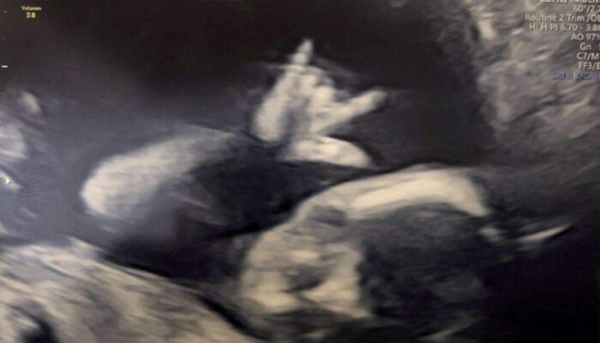 Unborn Baby Surprises Parents With a Heavy-Metal Rock Sign During Week-19 Ultrasound