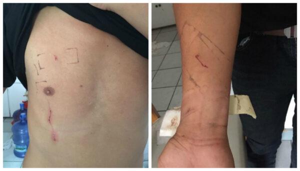 Saipan activist Yuan Feng Kung shows the cuts on his chest and arm. (Courtesy of Li Min)