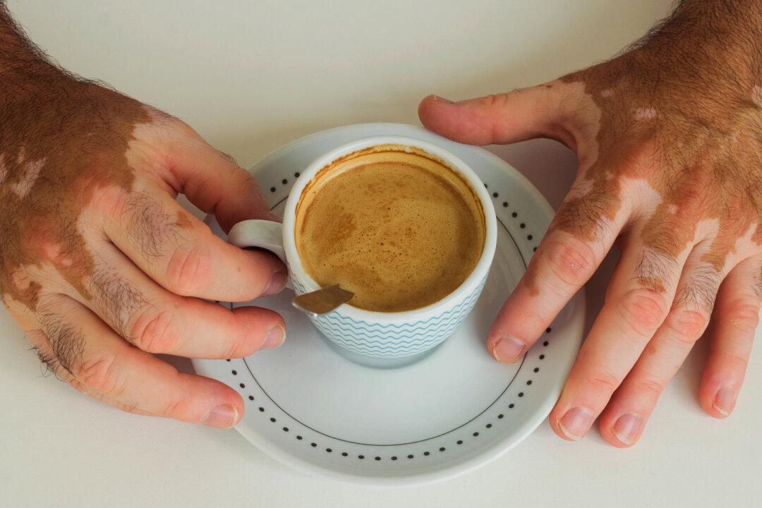 Man With Vitiligo Was Bullied in School, Then a Selfie Lands Him a Modeling Career