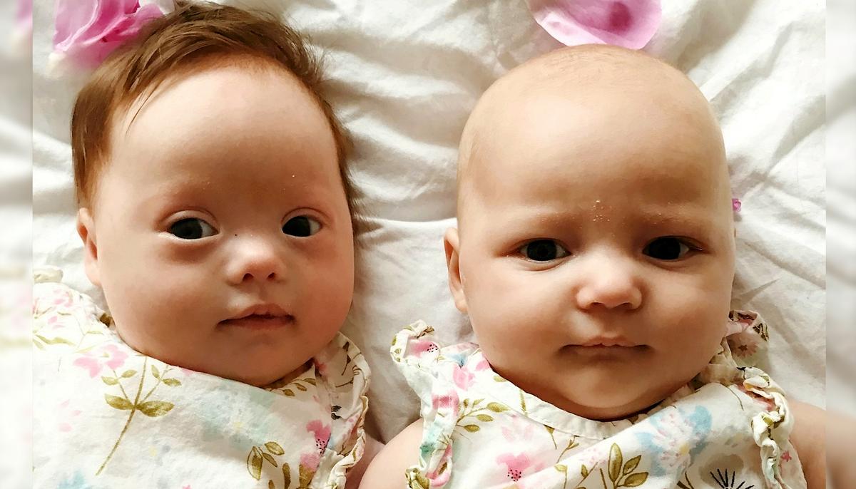 ‘One-in-a-Million’ Twins: One Born With Down Syndrome, and the Other Without