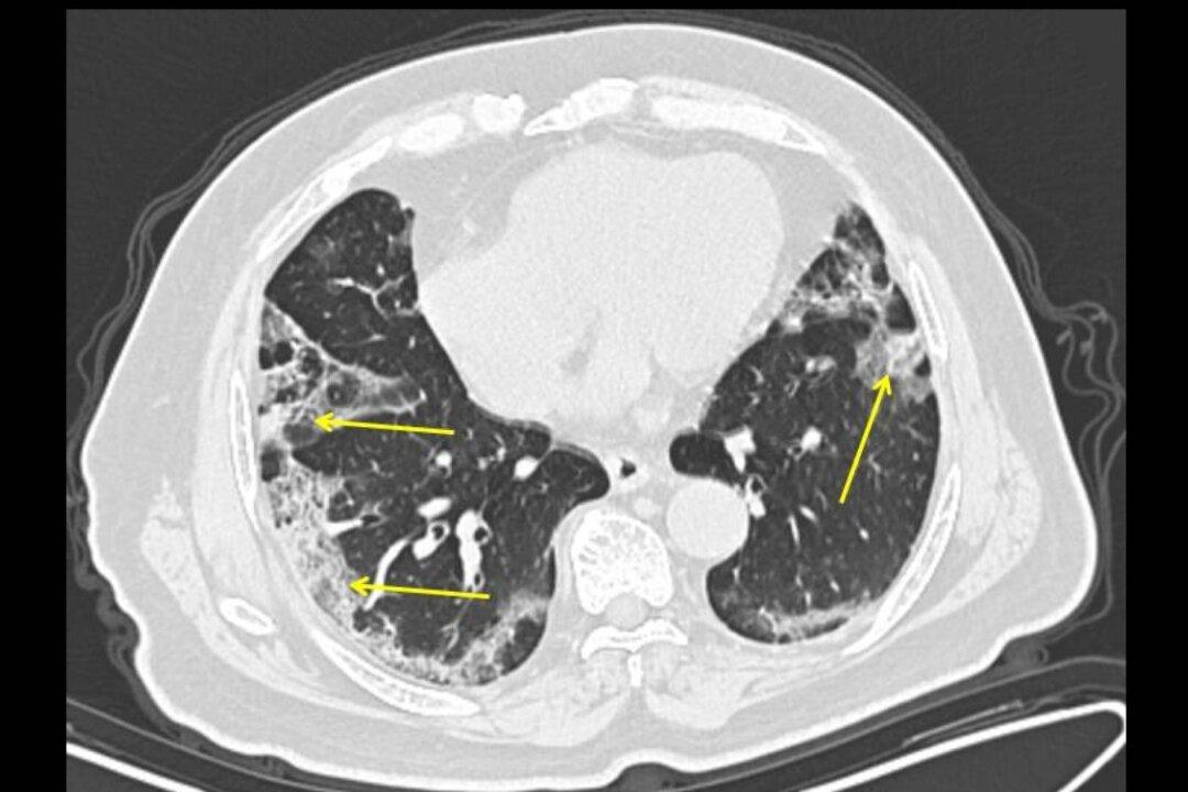 First US Doctors to Analyze Coronavirus Patients’ Lungs Say It Could Lead to Quicker Diagnosis