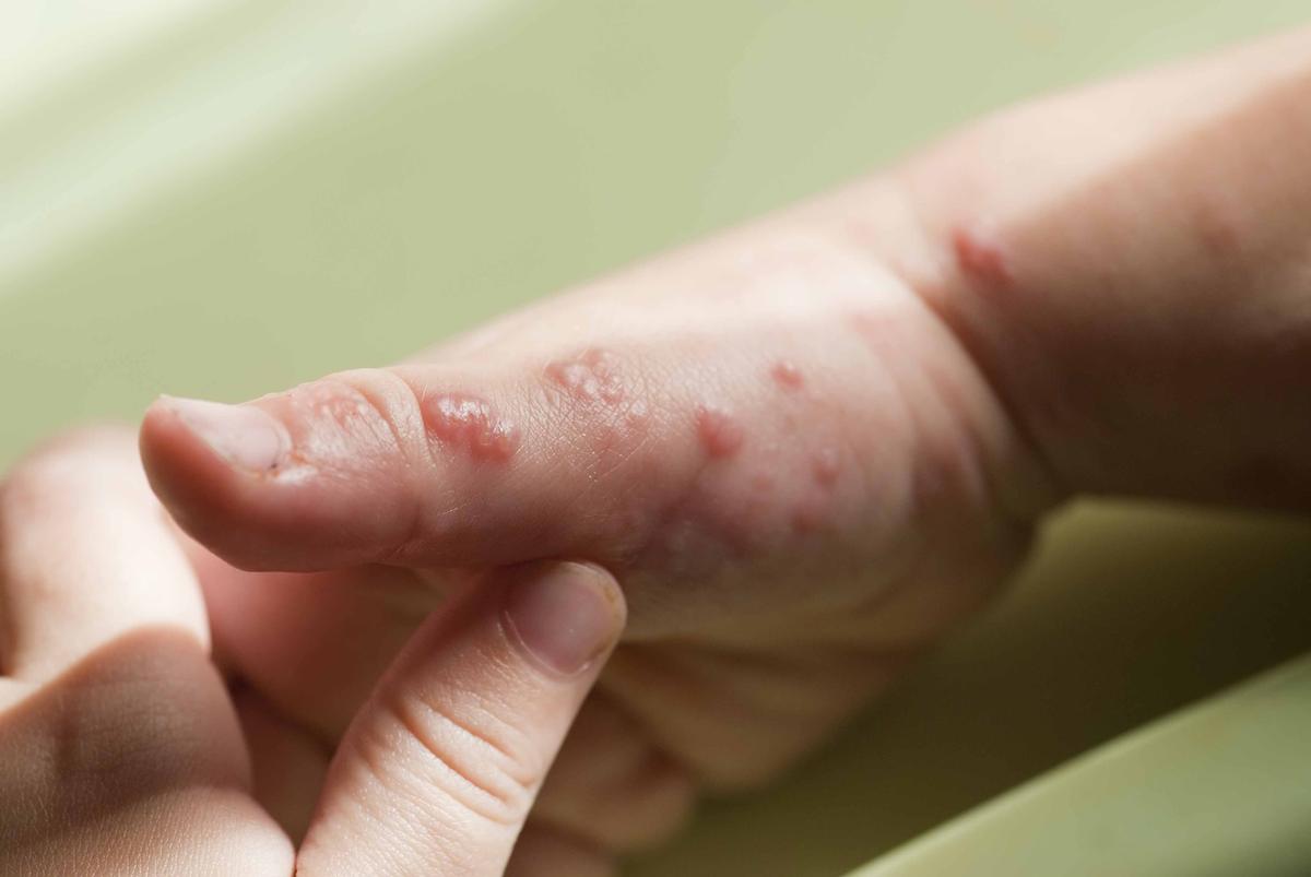 Illustration - Shutterstock | <a href="https://www.shutterstock.com/image-photo/blisters-caused-by-herpes-zoster-hand-100066778">Angel Simon</a>