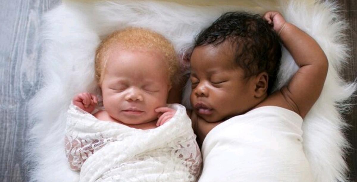 Photographer Gives Birth to Twins, One Black, the Other White, Takes Stunning Photos of Albino Daughter