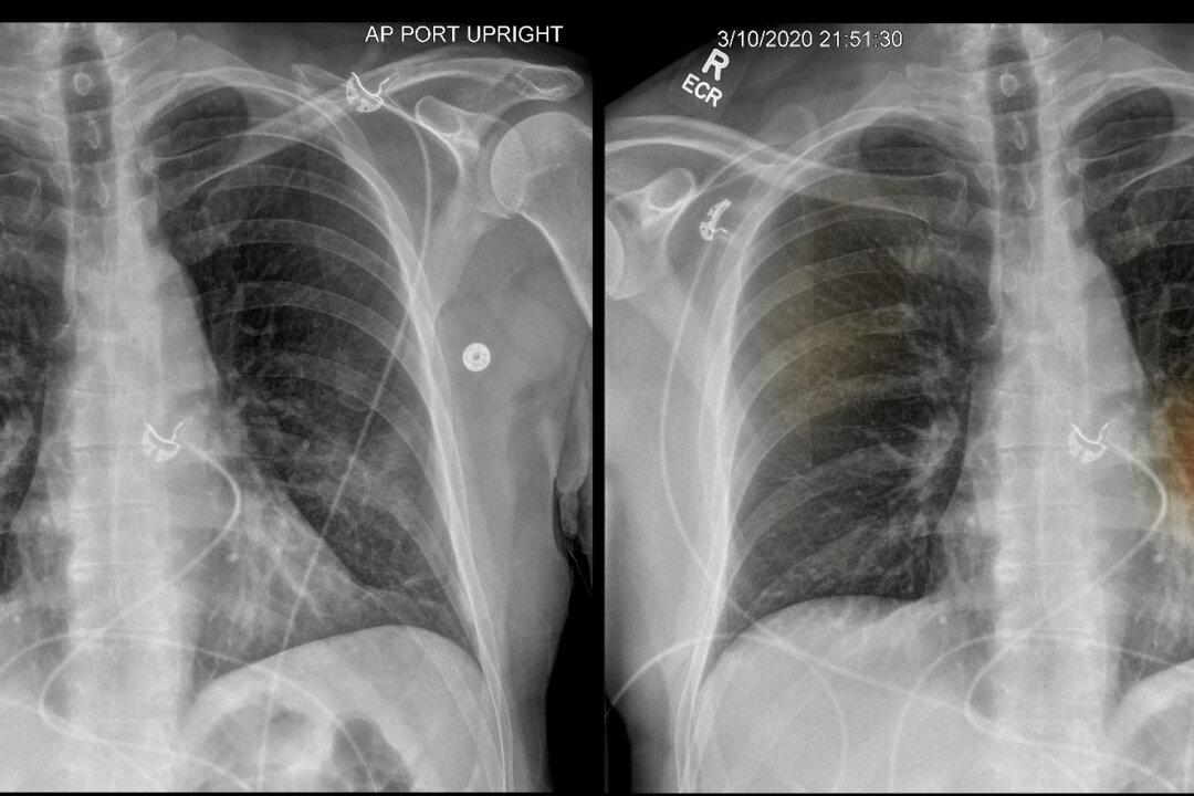 Coronavirus Tests the Value of Artificial Intelligence in Medicine