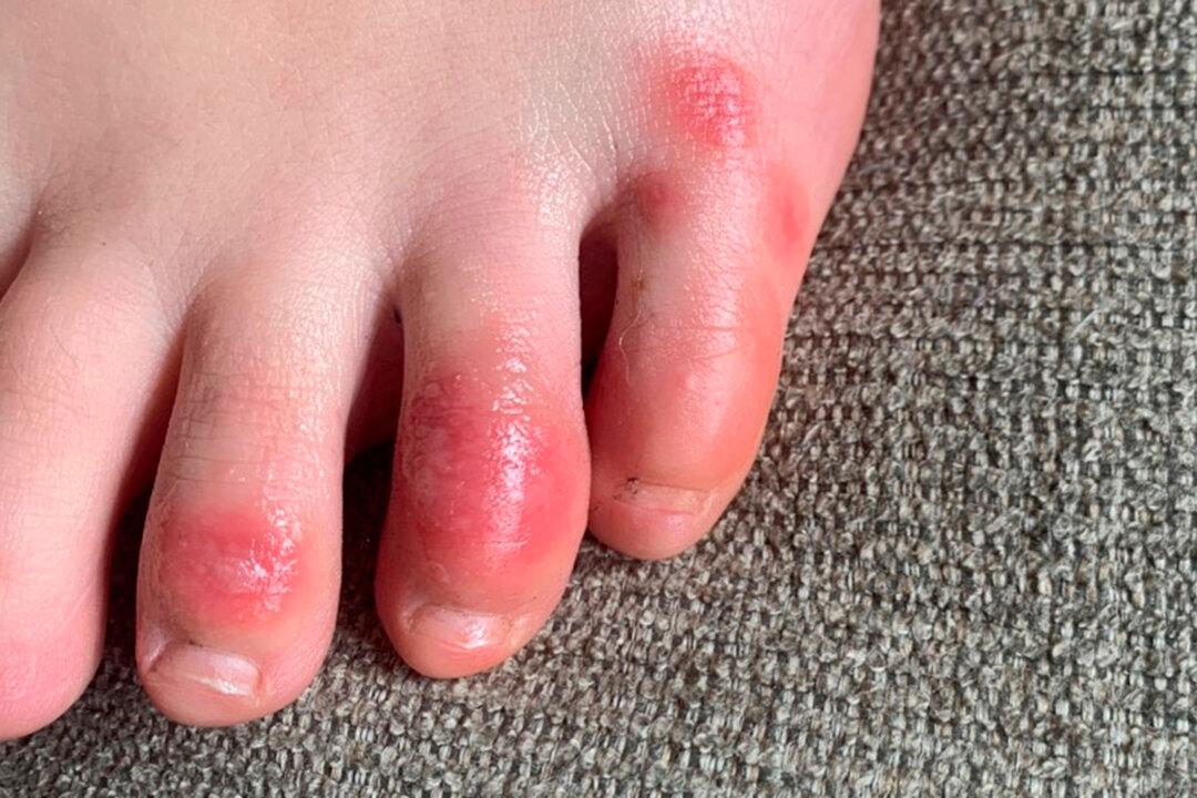 ‘COVID Toes,’ Other Rashes Latest Possible Rare Virus Signs