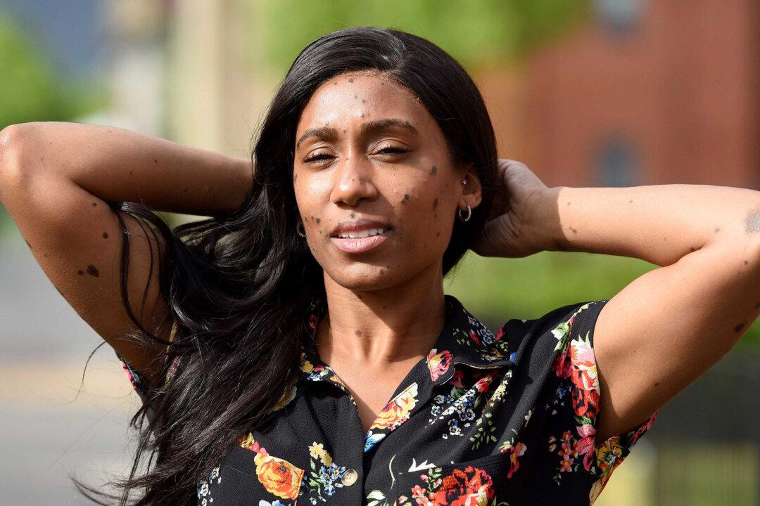 Bullies Called Her ‘Dalmatian’ Because of Her Skin Condition–Then She Became a Model