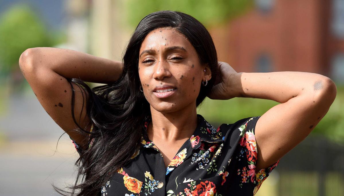 Bullies Called Her ‘Dalmatian’ Because of Her Skin Condition–Then She Became a Model