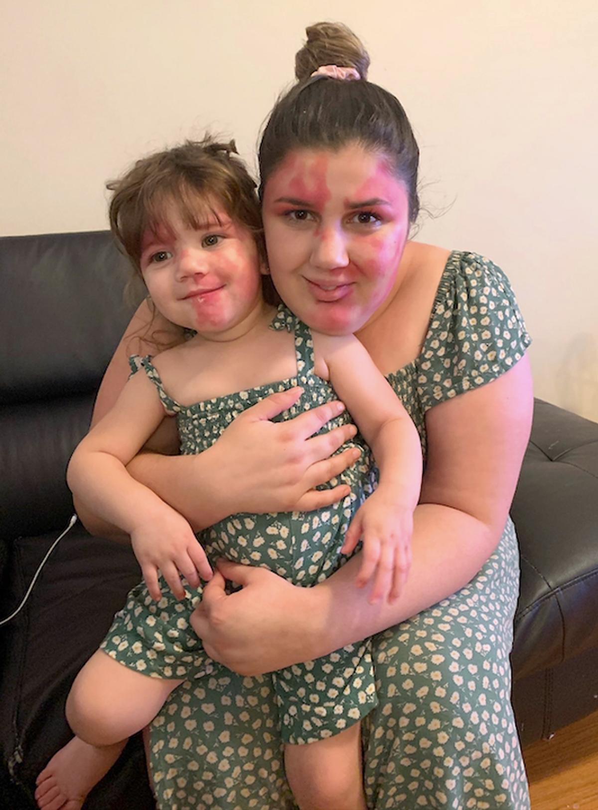 Marianna Bowering matching her daughter Angelica's dress and unique facial birthmark. (Caters News)