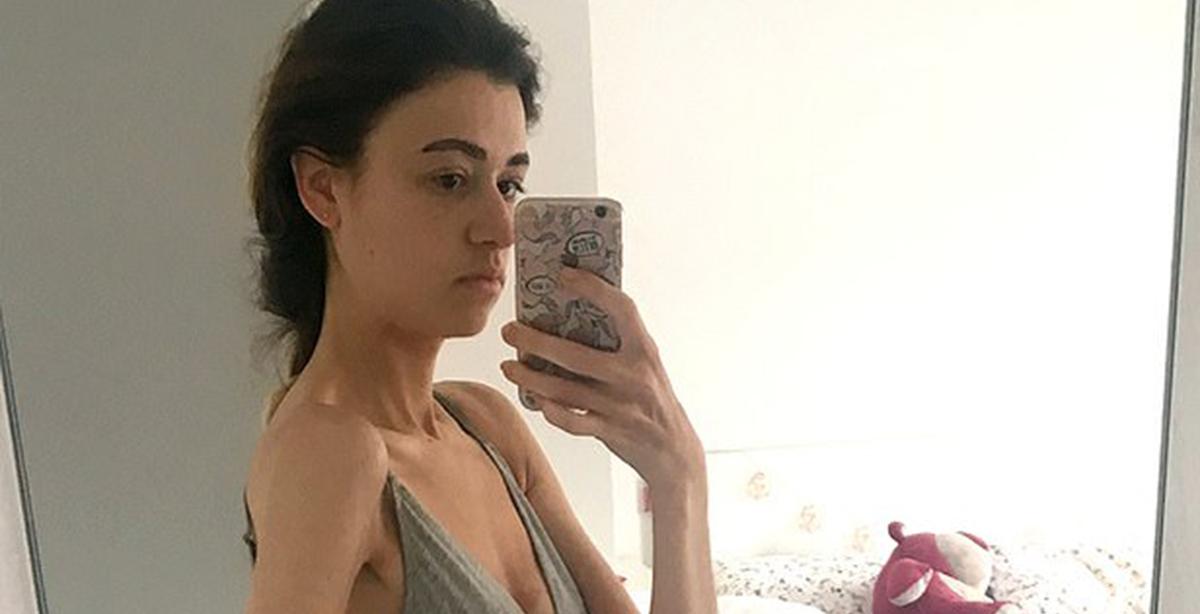 Anorexic Woman Beats Eating Disorder After Doctors Warn Her Organs Can Fail on Flight