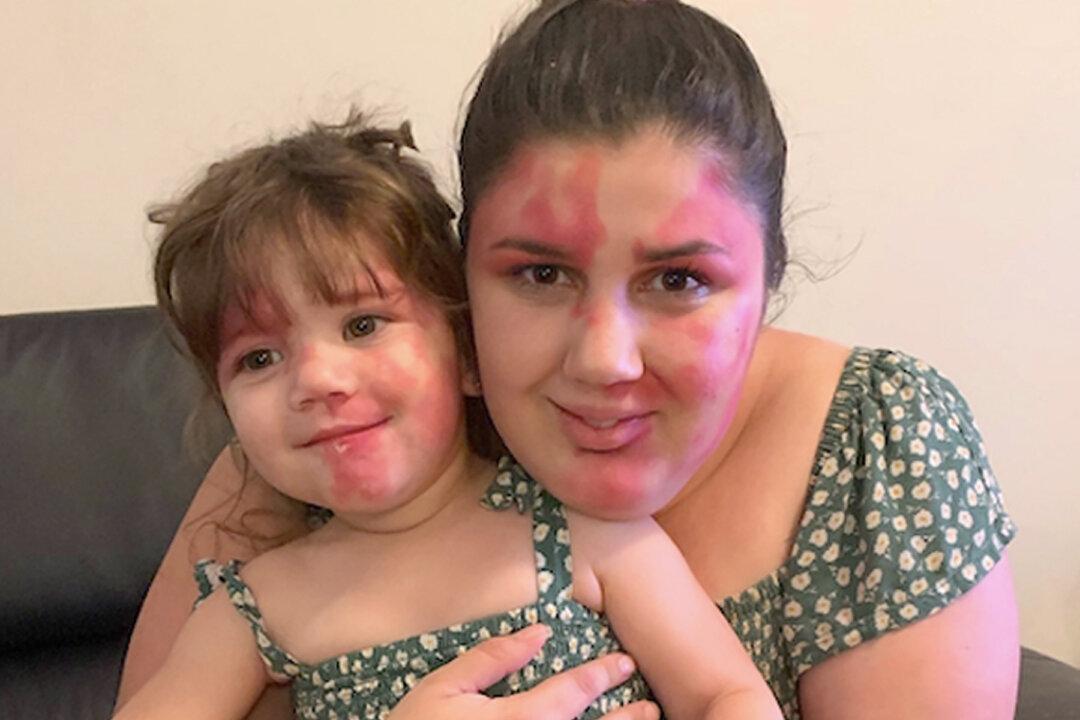 Mom Paints Face to Match Toddler’s Facial Birthmark: ‘I Wanted to Be Just as Beautiful as Her’