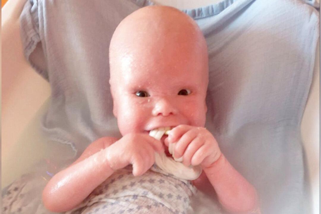 2-Year-Old With Painful Skin Condition Makes People Think He’s ‘A Doll’ but Has a ‘Wonderful Nature’