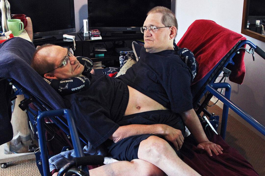 World’s Longest-Surviving Conjoined Twin Brothers Die at the Age of 68